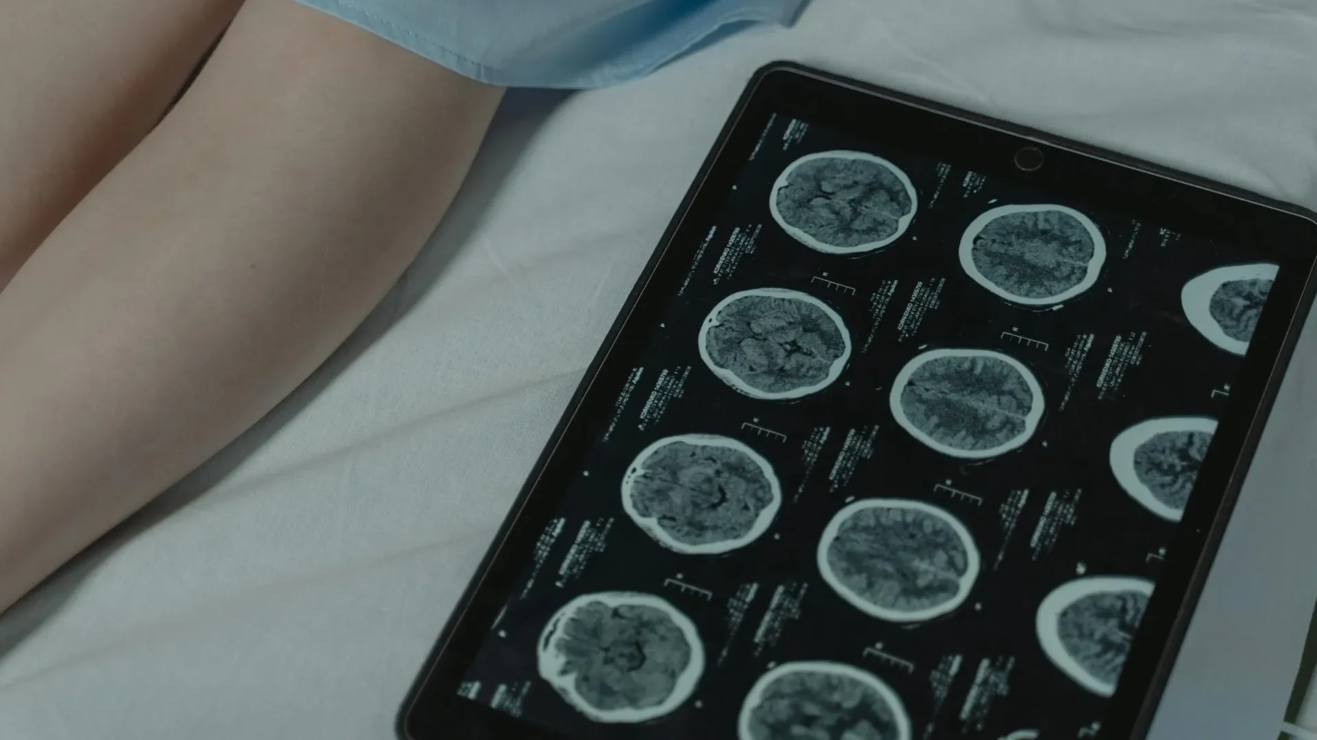 Revolución en el Diagnóstico de Gliomas Malignos 2